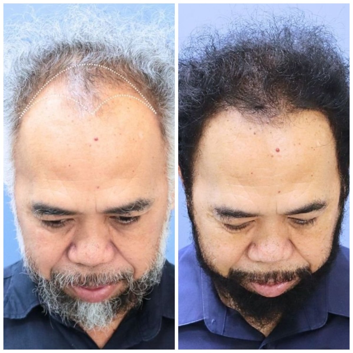 نتائج زراعة الشعر قبل وبعد في مستشفى إنترارات، استعادة خط وكثافة الشعر