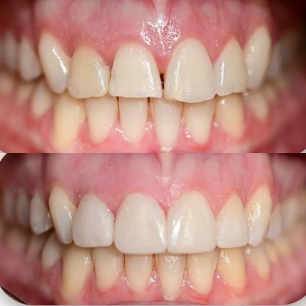 Antes y después de carillas Hollywood Smile en Punta cana dentist odontologia familiar, resultado
