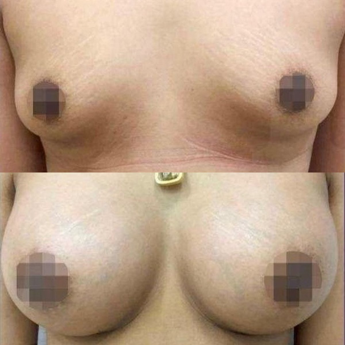 Before and after breast augmentation results – enhanced breast size and shape improvement