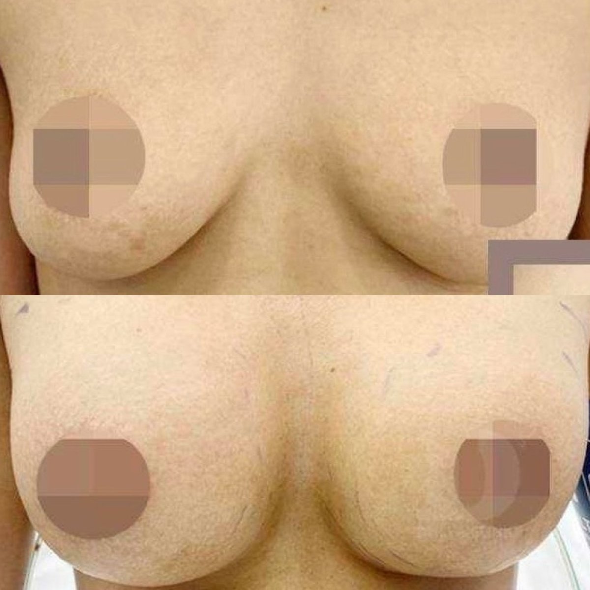Before and after breast augmentation results – enhanced breast volume and contour