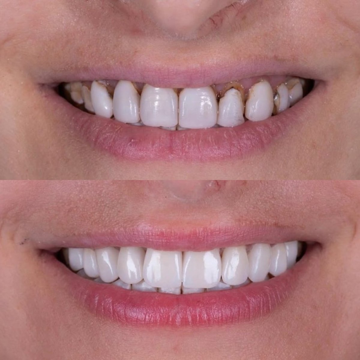 Before and after All-on-6 dental implants result at Shtern Dental Clinic, improved smile