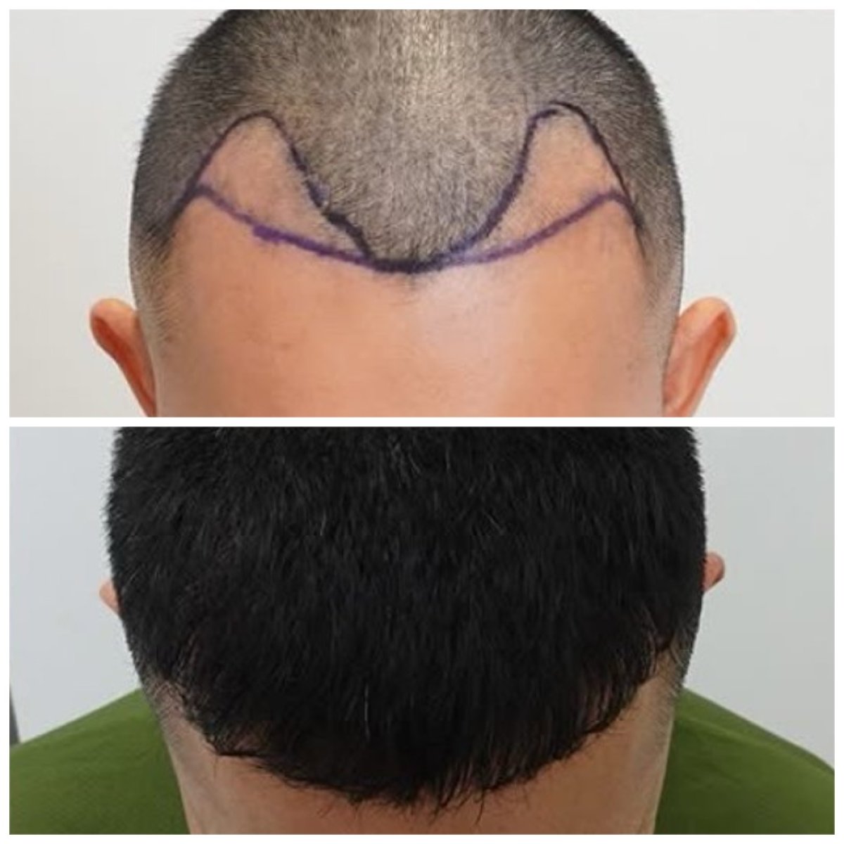 Before and after hair transplant results at Department of Skin & Surgery - NAVAMIN9 HOSPITAL