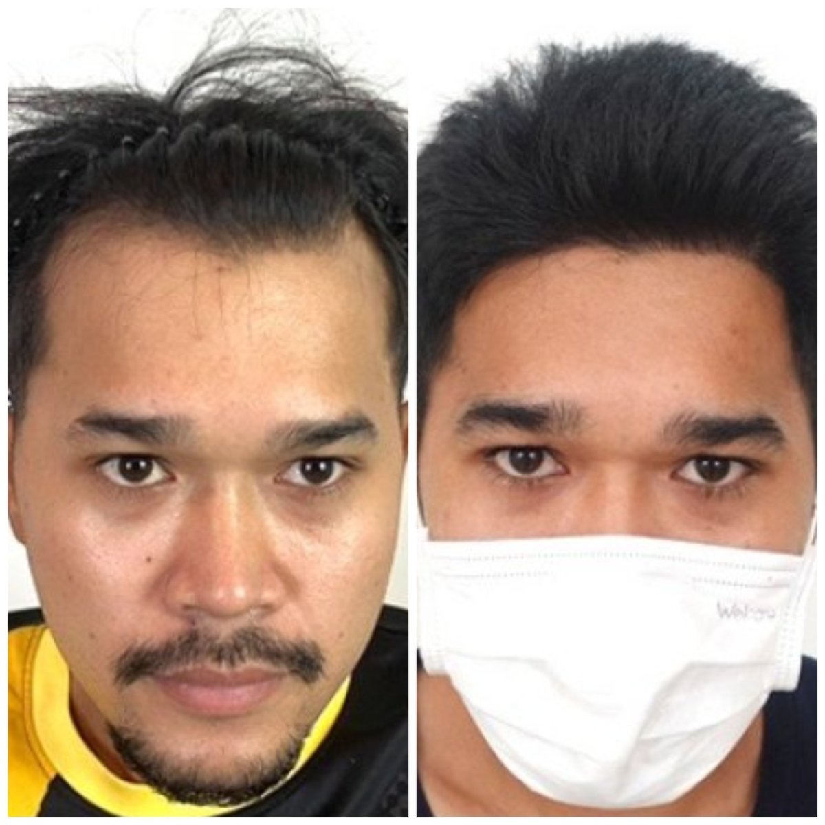 نتائج قبل وبعد زراعة الشعر في قسم الجلدية والجراحة - مستشفى نافامين9