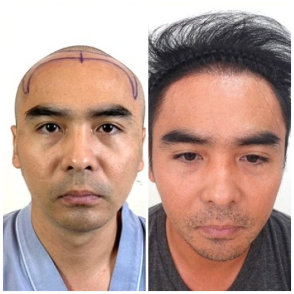 نتائج زراعة الشعر قبل وبعد في قسم الجلدية والجراحة - مستشفى نافامين9