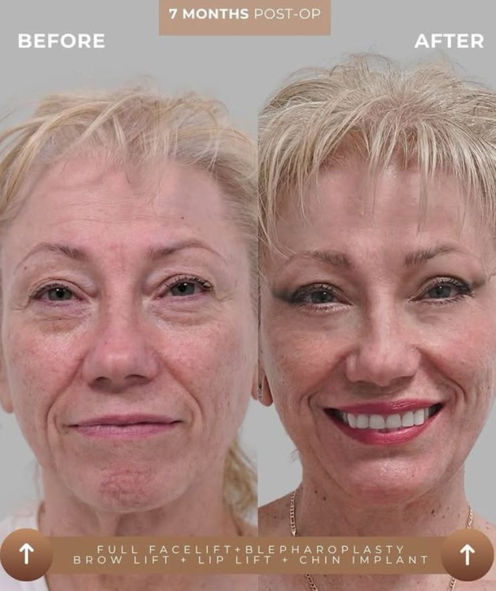 Before and after facelift, blepharoplasty, brow and lip lift at Hospital Cyntar Tijuana results