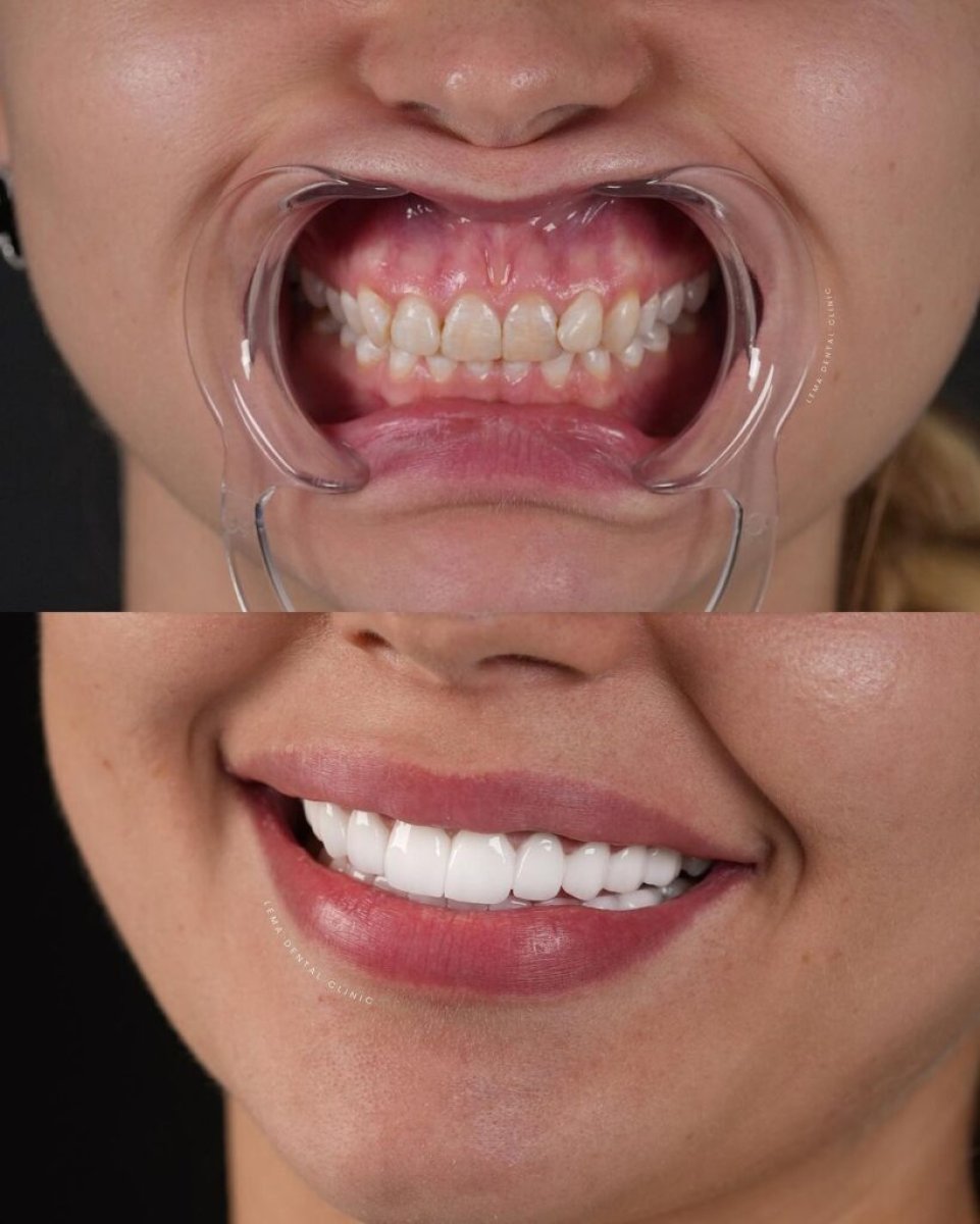 Результаты до и после установки фарфоровых виниров в Flex Dental Clinic – преображение улыбки