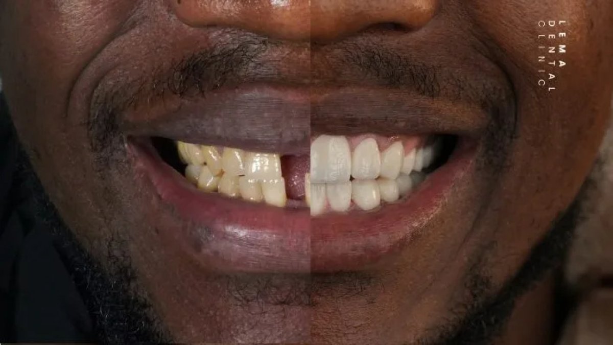 Efekty wybielania zębów przed i po w Lema Dental Clinic – jaśniejszy uśmiech