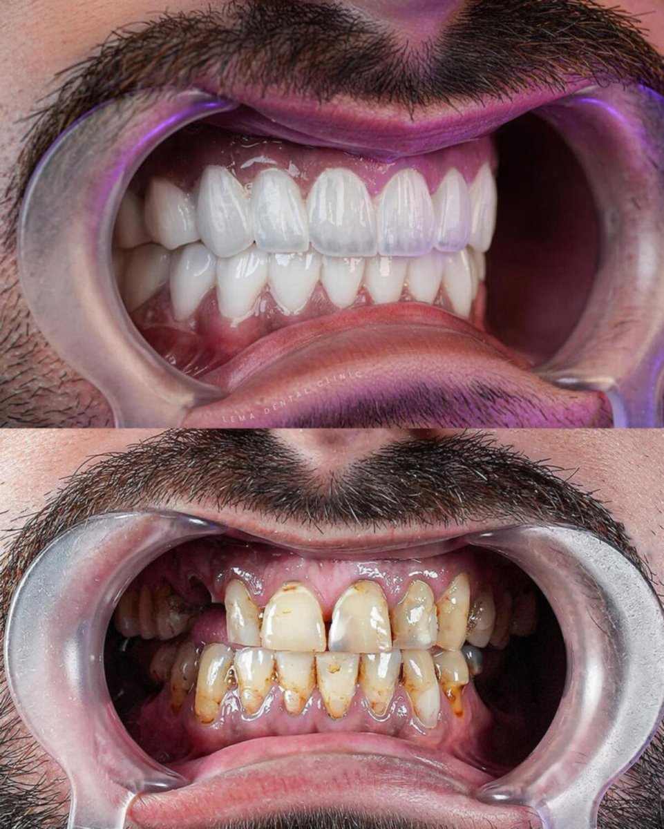 Before and after veneers at dental clinic – smile transformation with whiter, even teeth result