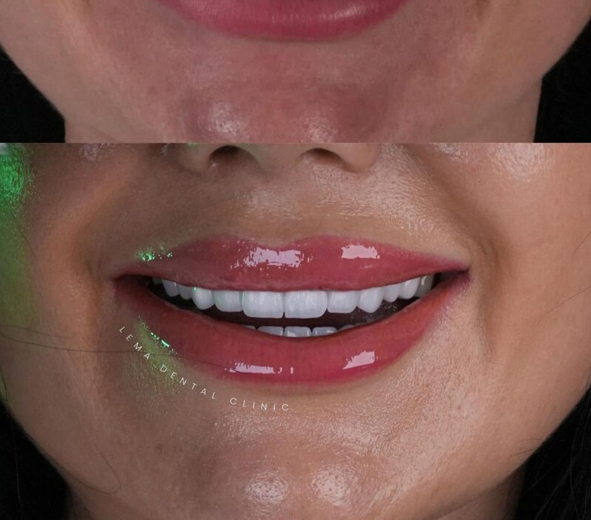 Результат до и после виниров в Lema Dental Clinic – преображение улыбки винирами