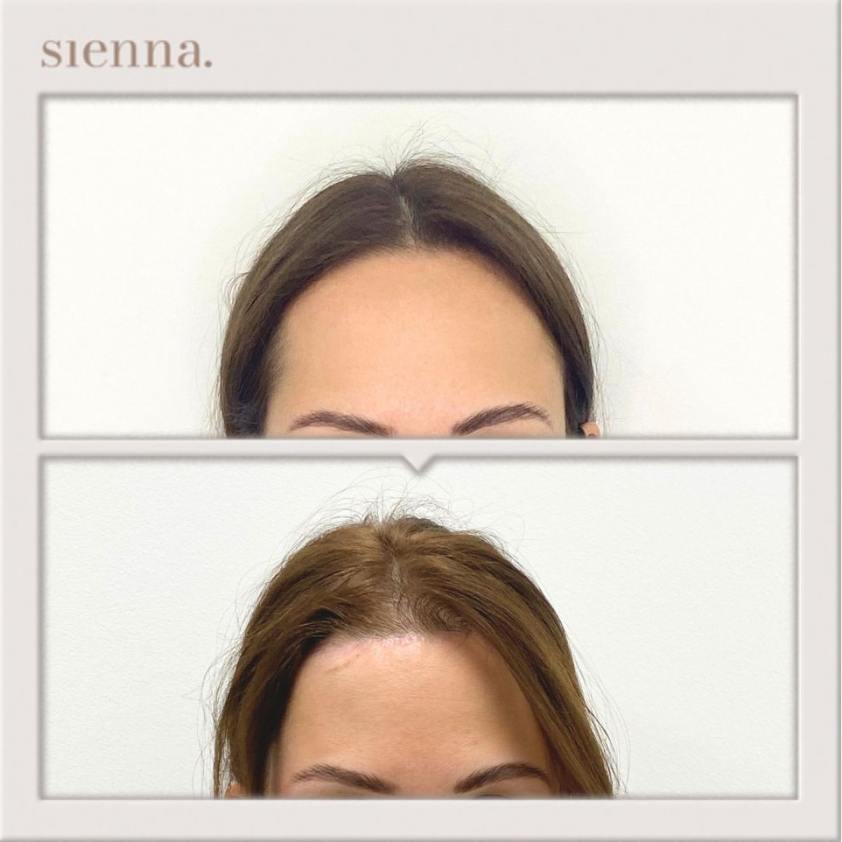 Résultats lifting du front avant/après à Sienna Clinic, front visiblement plus lisse