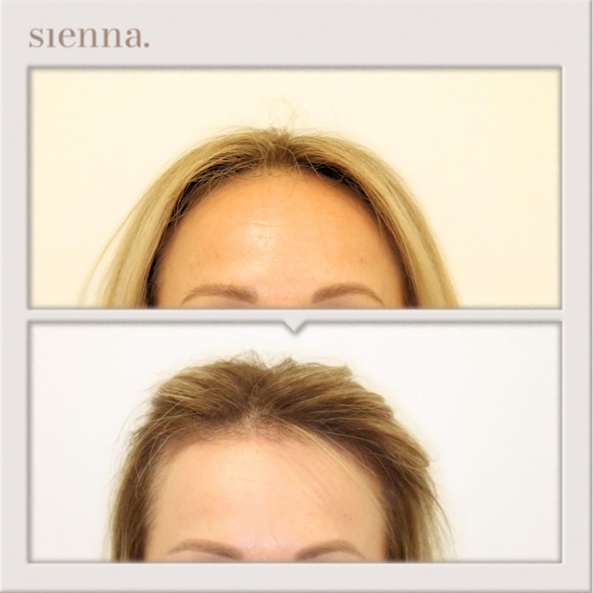 Resultados de lifting de frente antes y después en Sienna Clinic, frente lisa y cejas elevadas