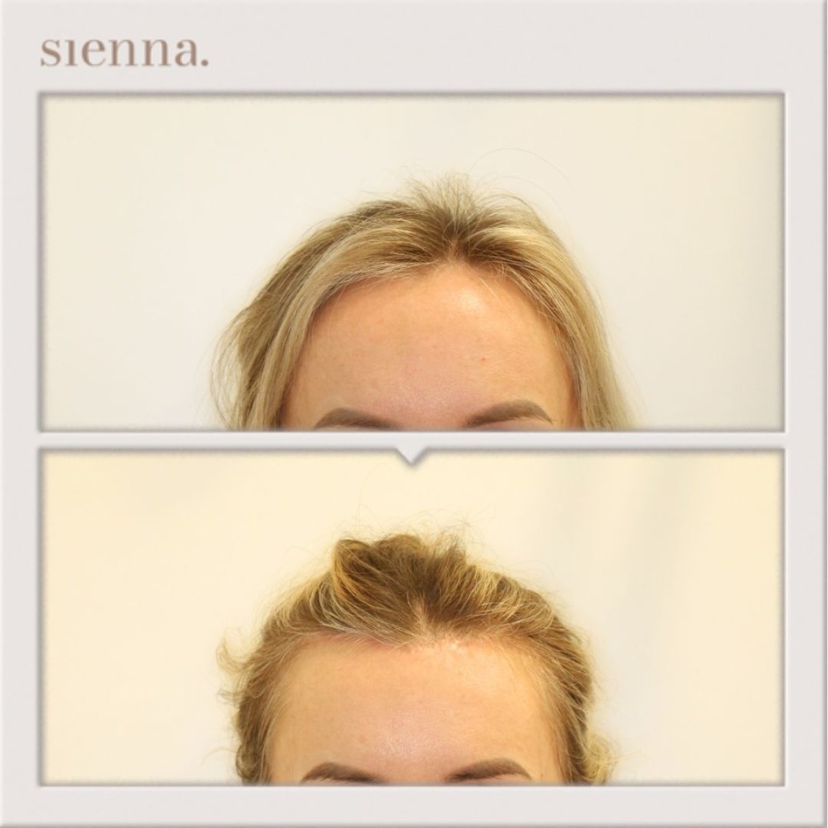 Resultados de lifting de frente antes y después en Sienna Clinic, frente más lisa y elevada