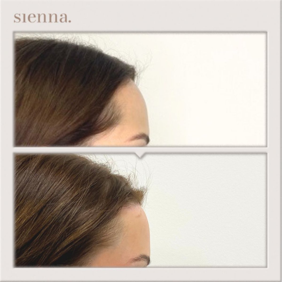 Результаты подтяжки лба до и после в Sienna Clinic, заметно более гладкий контур лба