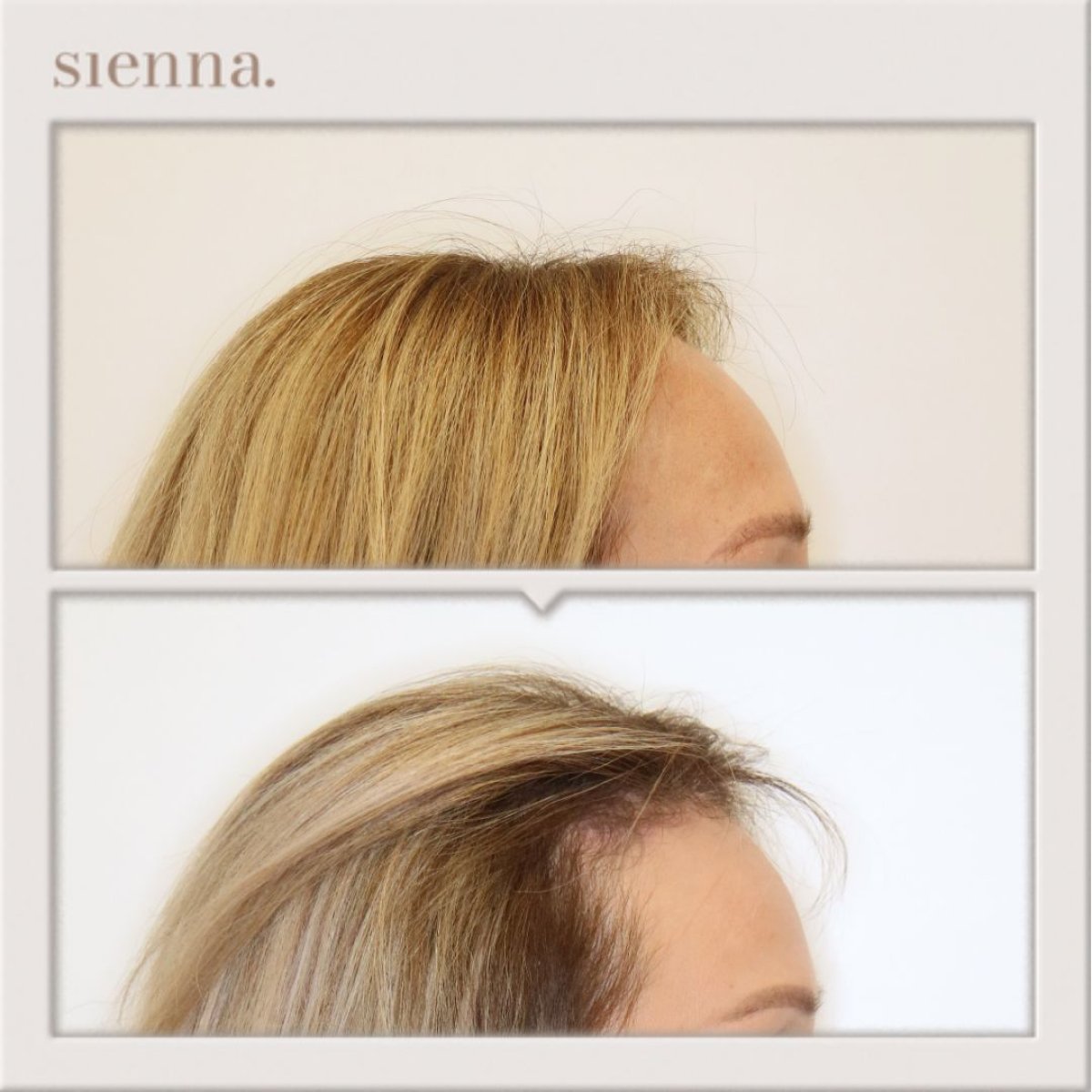Résultats lifting du front avant/après à Sienna Clinic, front visiblement plus lisse