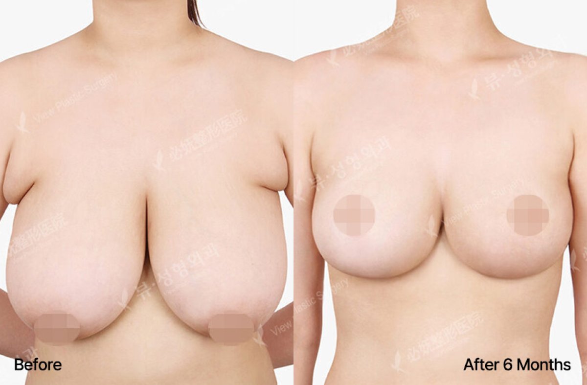 Résultats avant et après réduction mammaire à View Plastic Surgery Hospital, forme améliorée