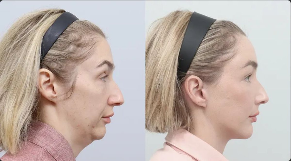 Результаты до и после SMAS-лифтинга в AB Plastic Surgery, улучшение овала лица и шеи