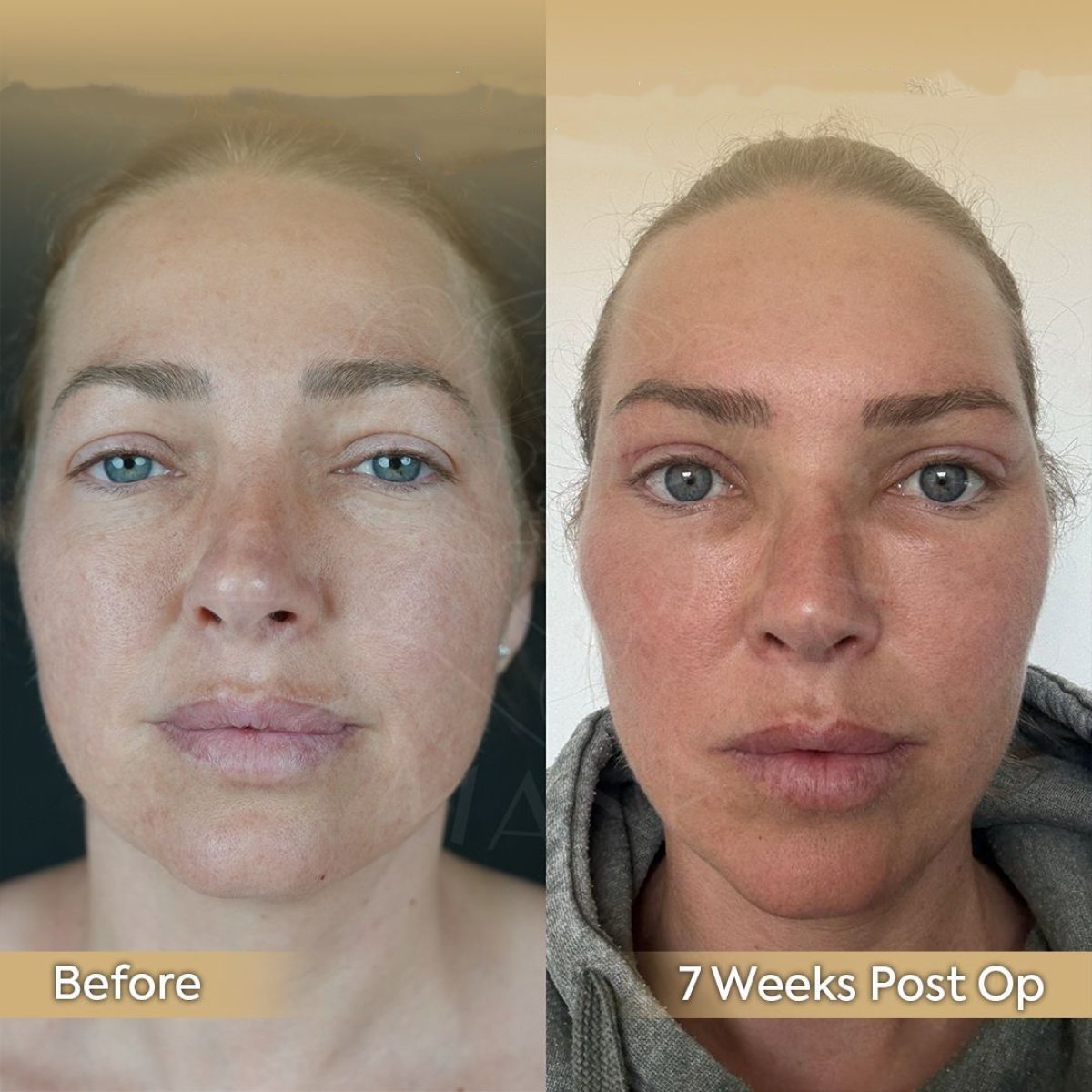 Before and after facial fat transfer at Dr. Safa Manav Clinic, 7 weeks post-op results