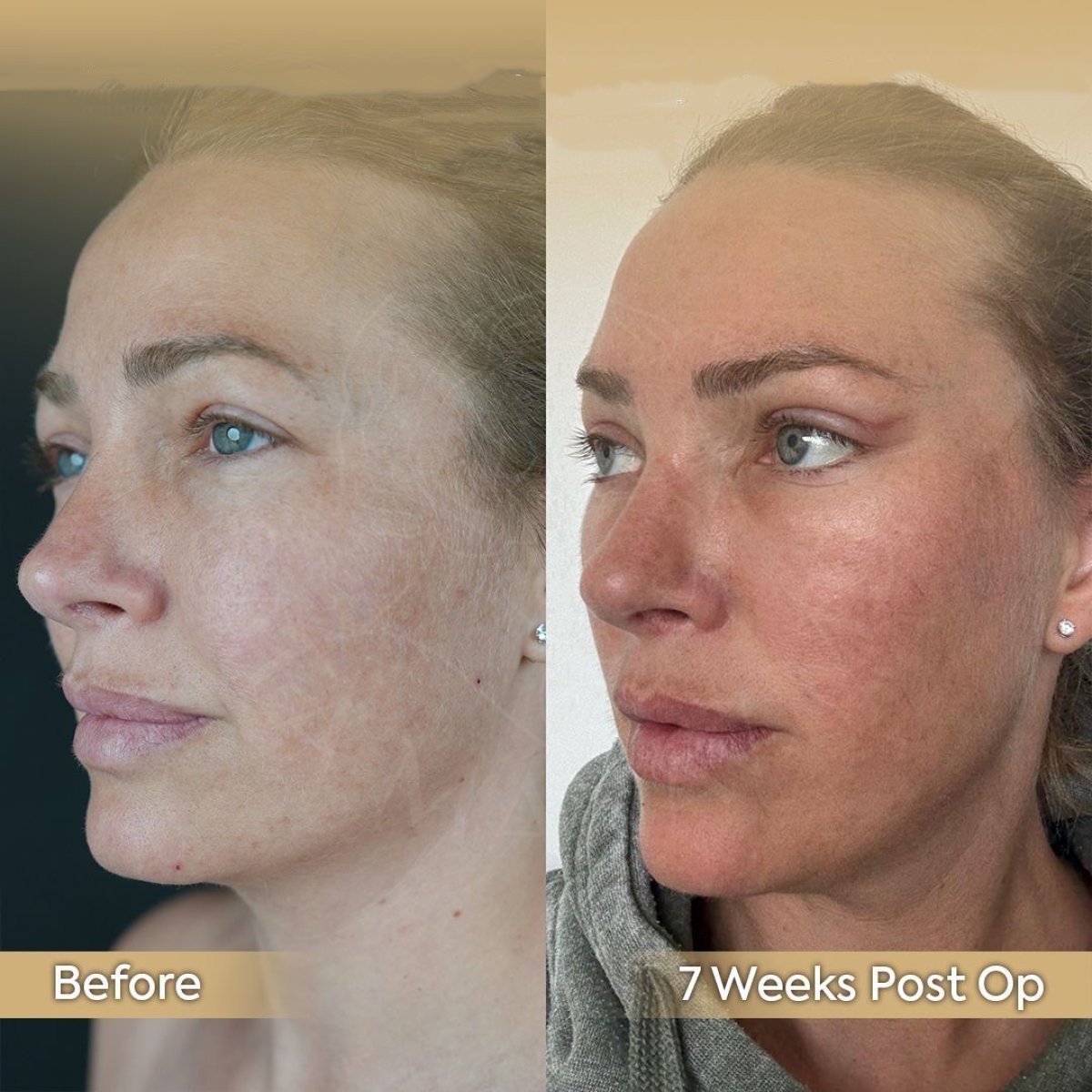 Vorher-nachher-Ergebnis des Facial Fat Transfers in der Dr. Safa Manav Klinik, 7 Wochen post-op