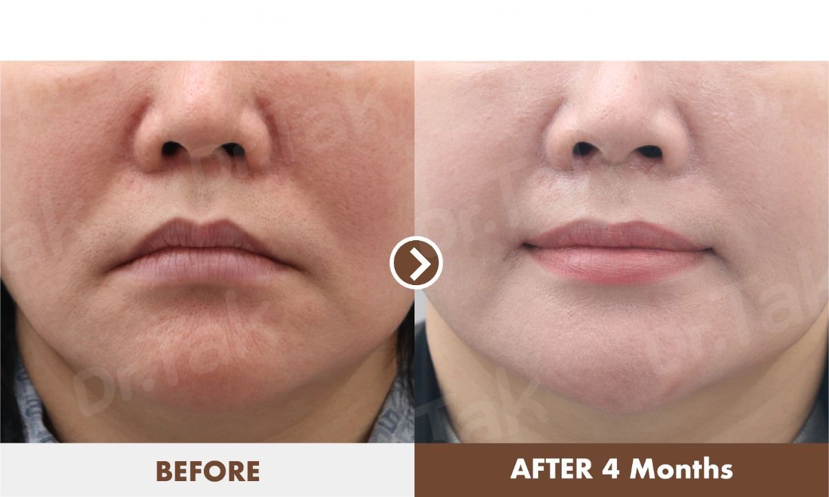 نتائج رفع الشفاه قبل وبعد في عيادة Dr. Tak Plastic Surgery، تحديد الشفاه بعد 4 أشهر