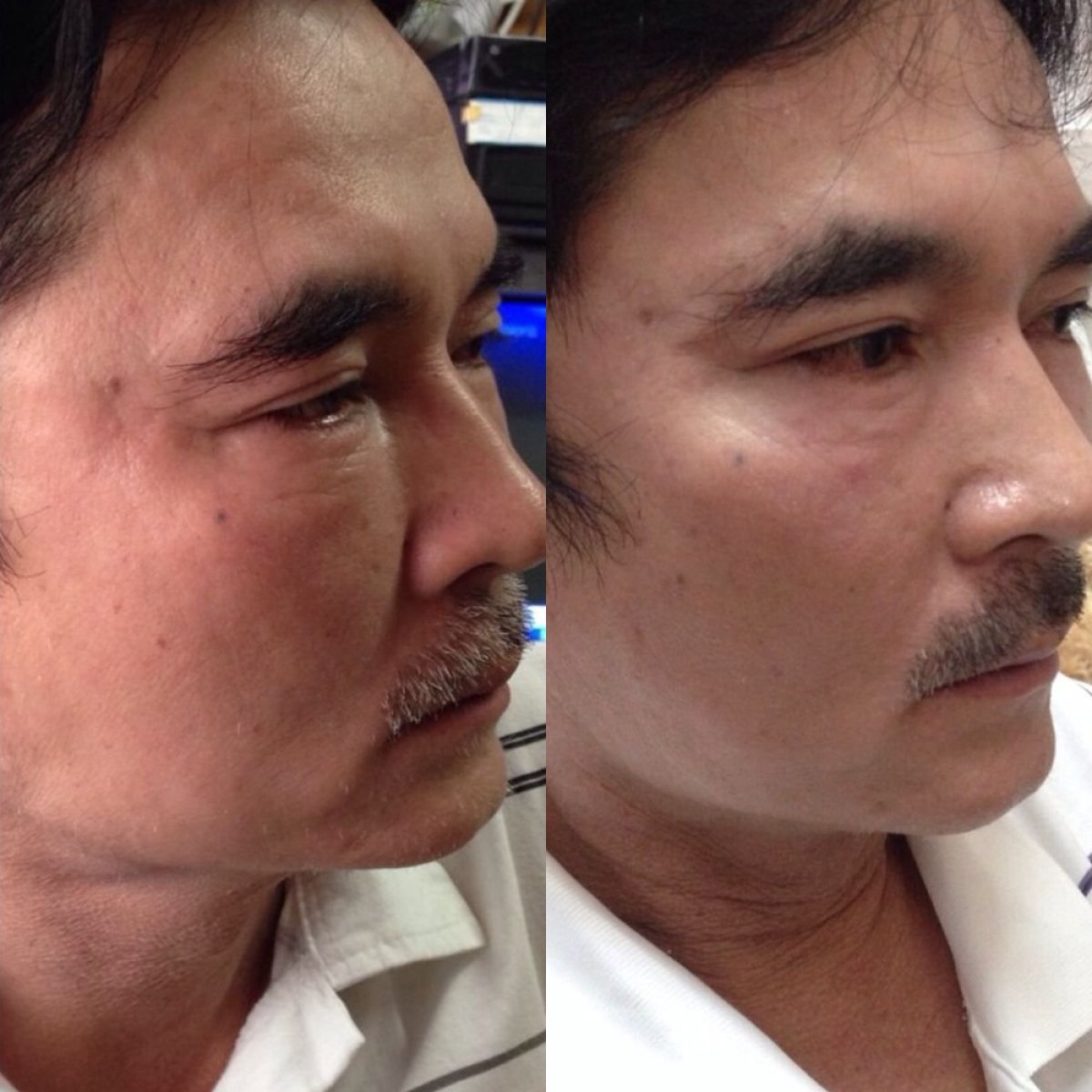 Antes y después de lifting con hilos en ASIA CLINIC, resultado de rejuvenecimiento facial