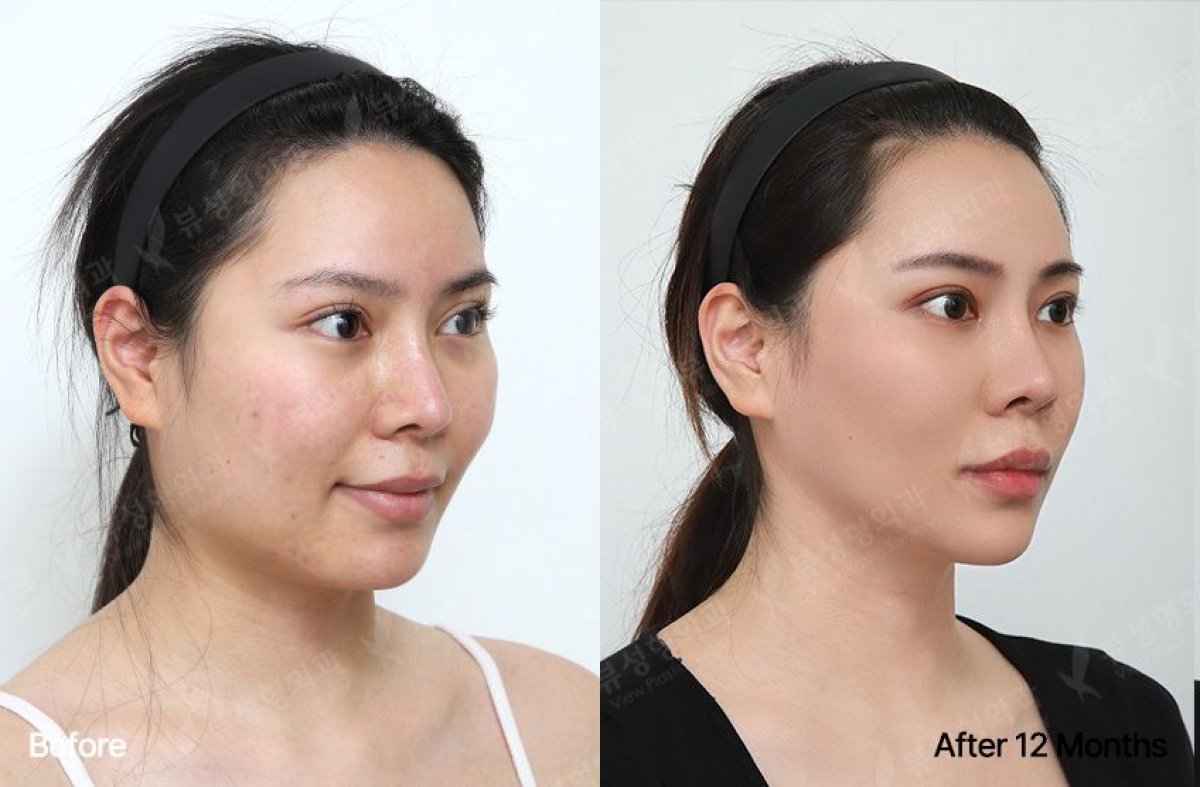 Efekty przed i po implantacji brody w View Plastic Surgery Hospital, poprawiony kontur brody