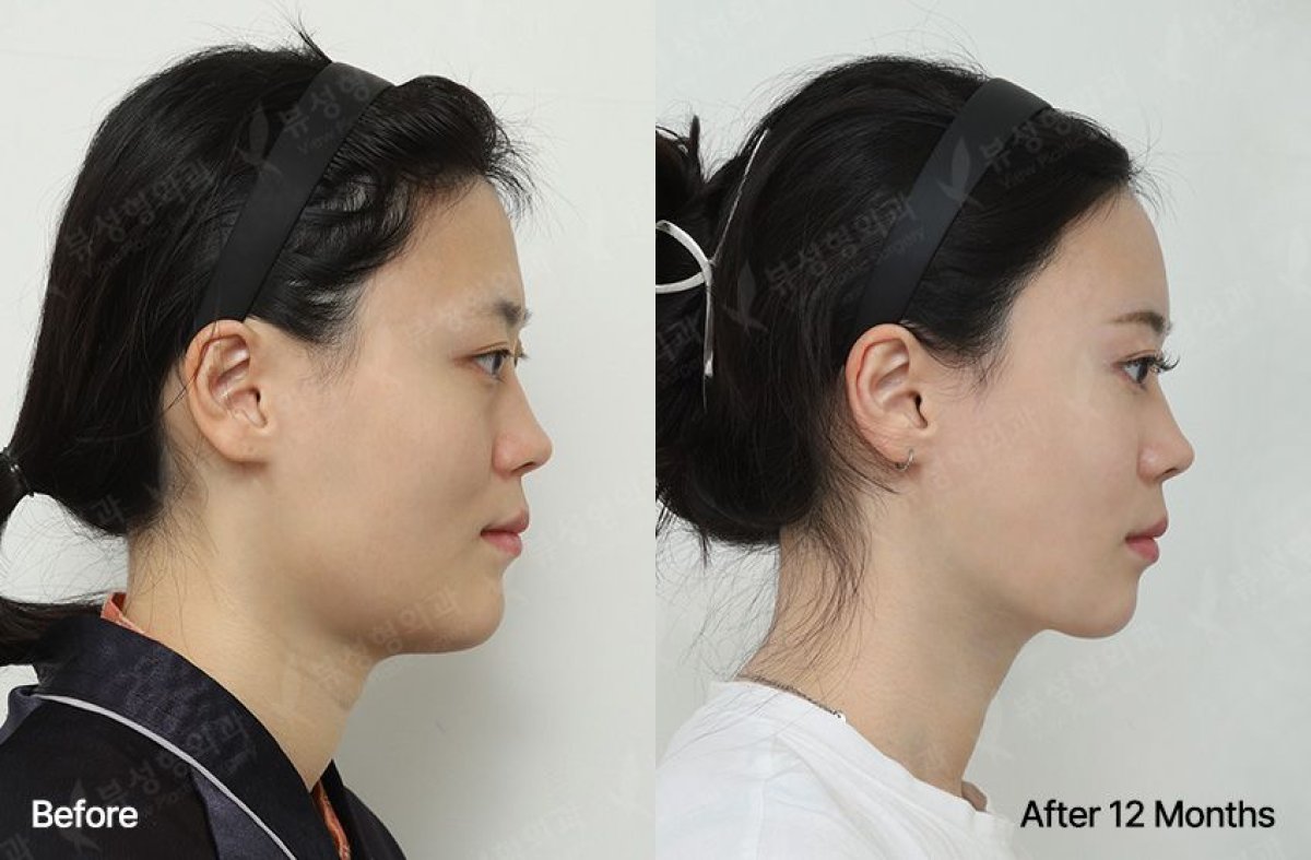 Efekty przed i po implantacji brody w View Plastic Surgery Hospital, poprawiony profil