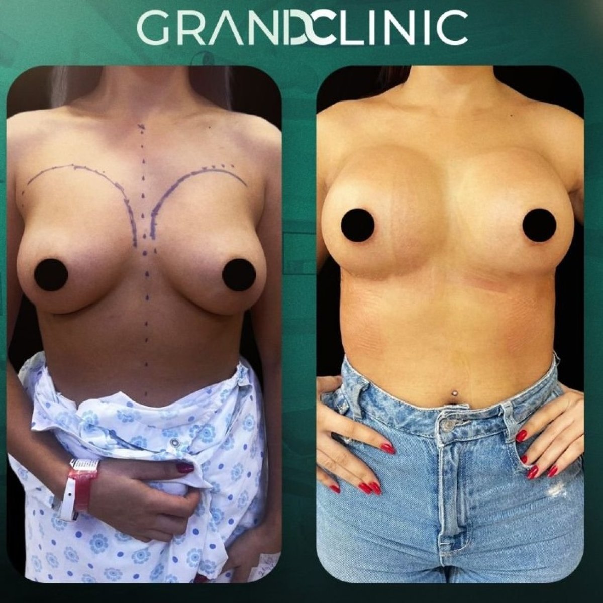 Результати до і після підтяжки грудей у Grand Clinic з покращеним контуром грудей