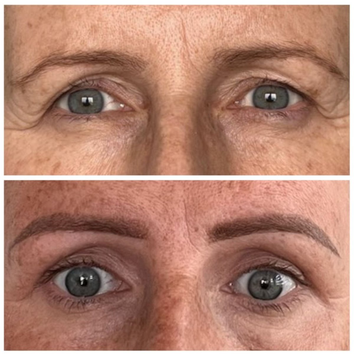 Upper eyelid surgery before and after results at Radzikowska Clinic, rejuvenated eye area