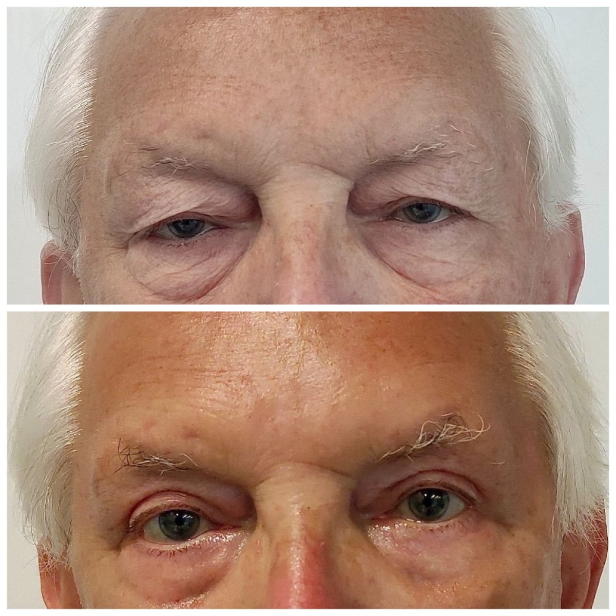 Before and after upper eyelid surgery results at Radzikowska Clinic, improved eye appearance