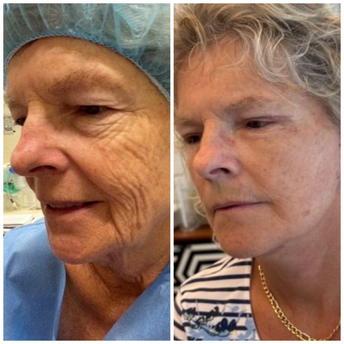 До и после Deep Plane Facelift в Radzikowska Clinic, видимый омолаживающий эффект