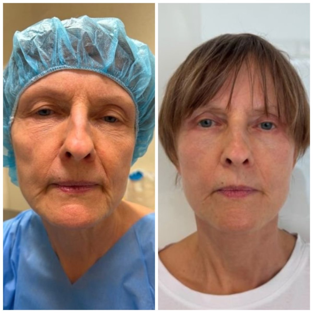 نتائج قبل وبعد شد الوجه العميق في Radzikowska Clinic، تجديد واضح للوجه