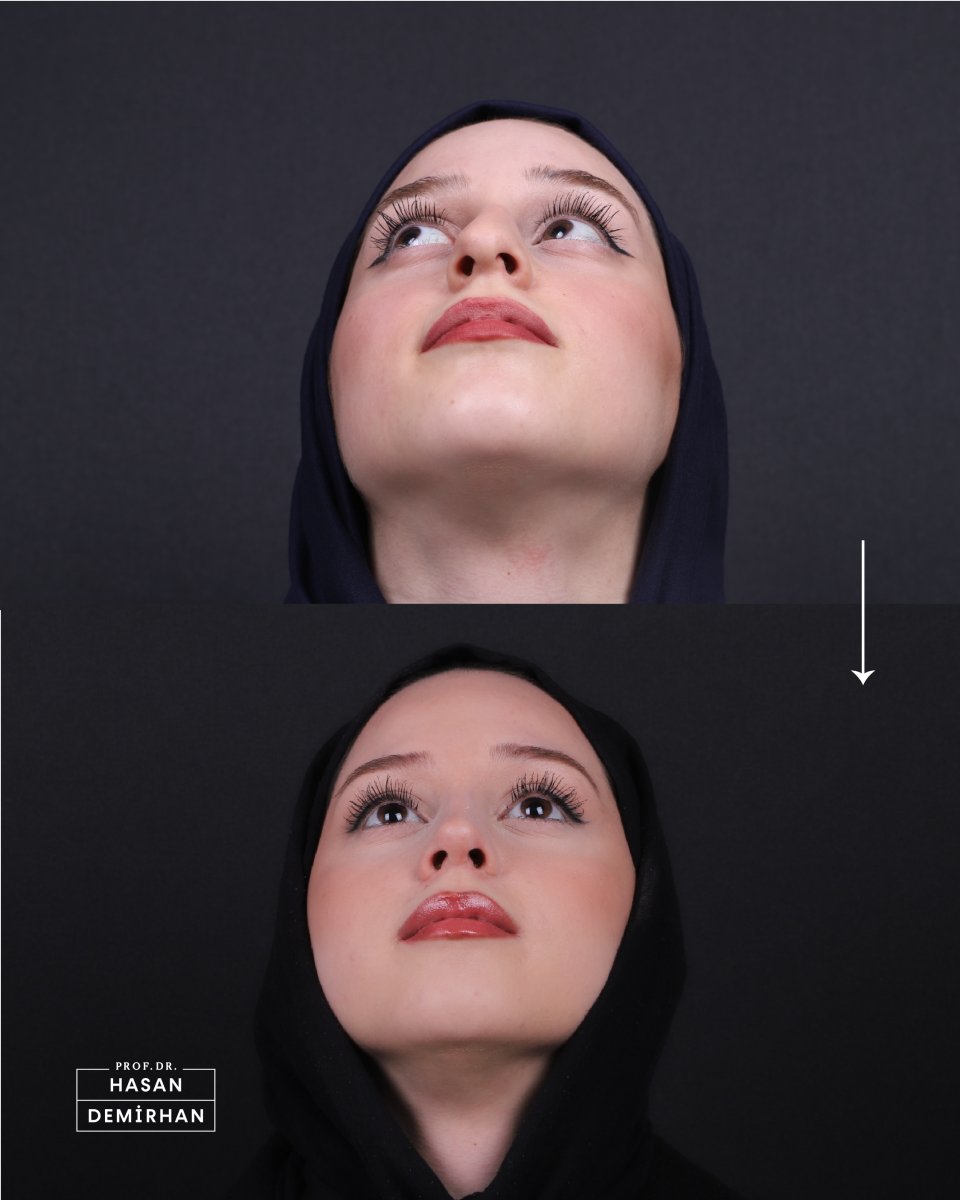 Before and after rhinoplasty results at Hasan Demirhan Clinic, improved nose shape
