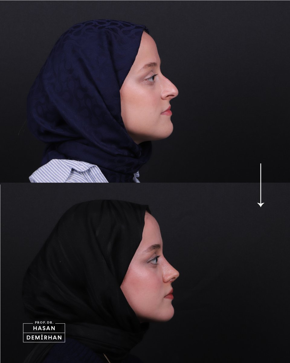 Before and after rhinoplasty results at Hasan Demirhan Clinic, improved nose profile