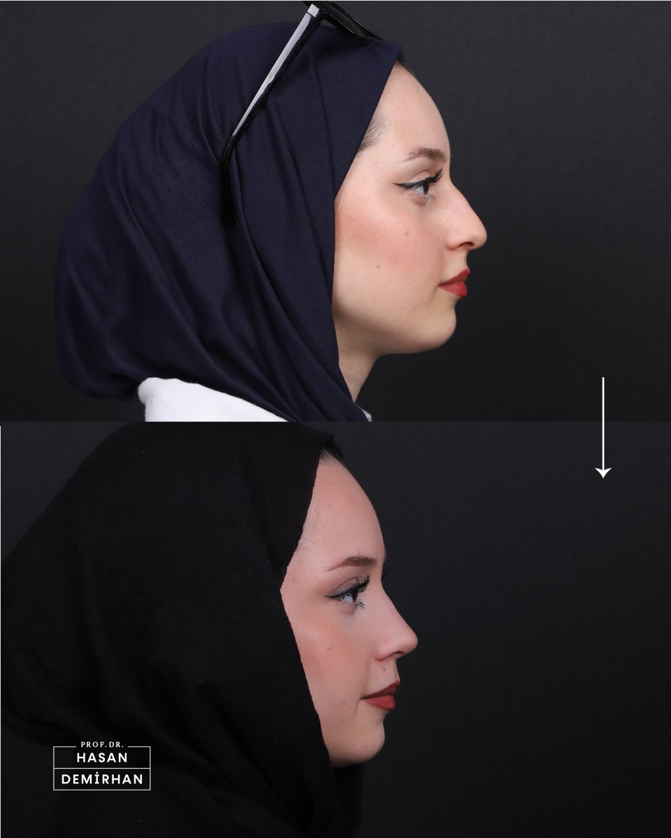 Resultados de rinoplastia antes y después en la clínica Hasan Demirhan – perfil nasal mejorado