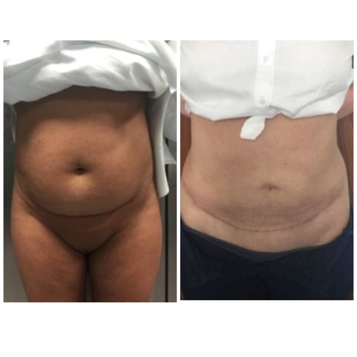 Before and after tummy tuck and liposuction results at Radzikowska Clinic, flatter abdomen