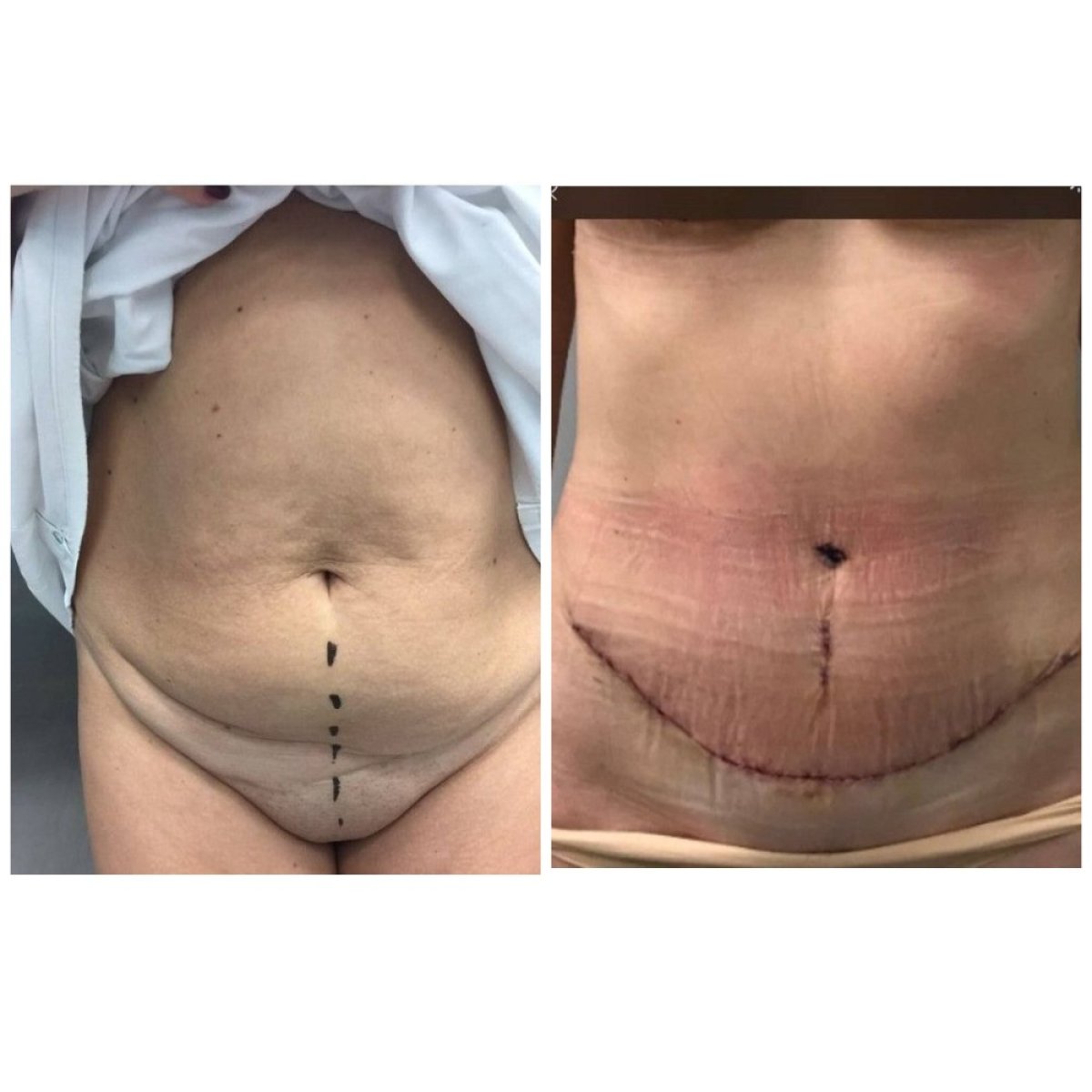 Before and after tummy tuck and liposuction results at Radzikowska Clinic, flatter abdomen