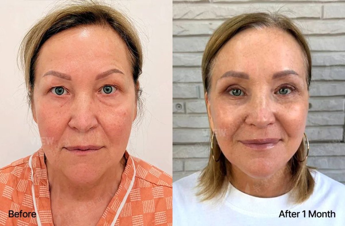 Before and after blepharoplasty results at View Plastic Surgery Hospital, eyelid correction