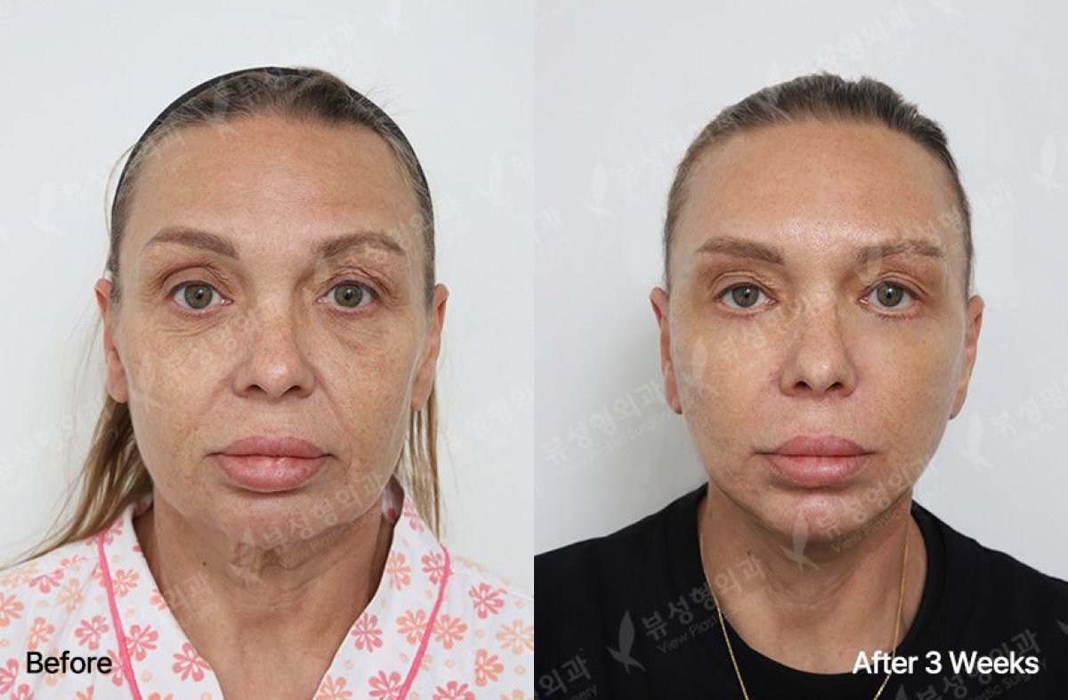 Blepharoplasty before and after results at View Plastic Surgery Hospital, eyelid correction outcome