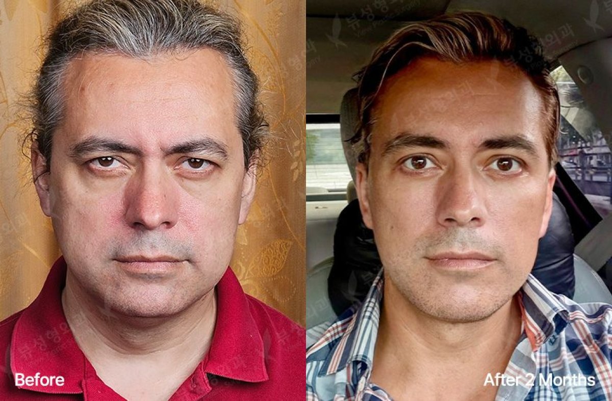 Блефаропластика до и после в View Plastic Surgery Hospital, результат коррекции век