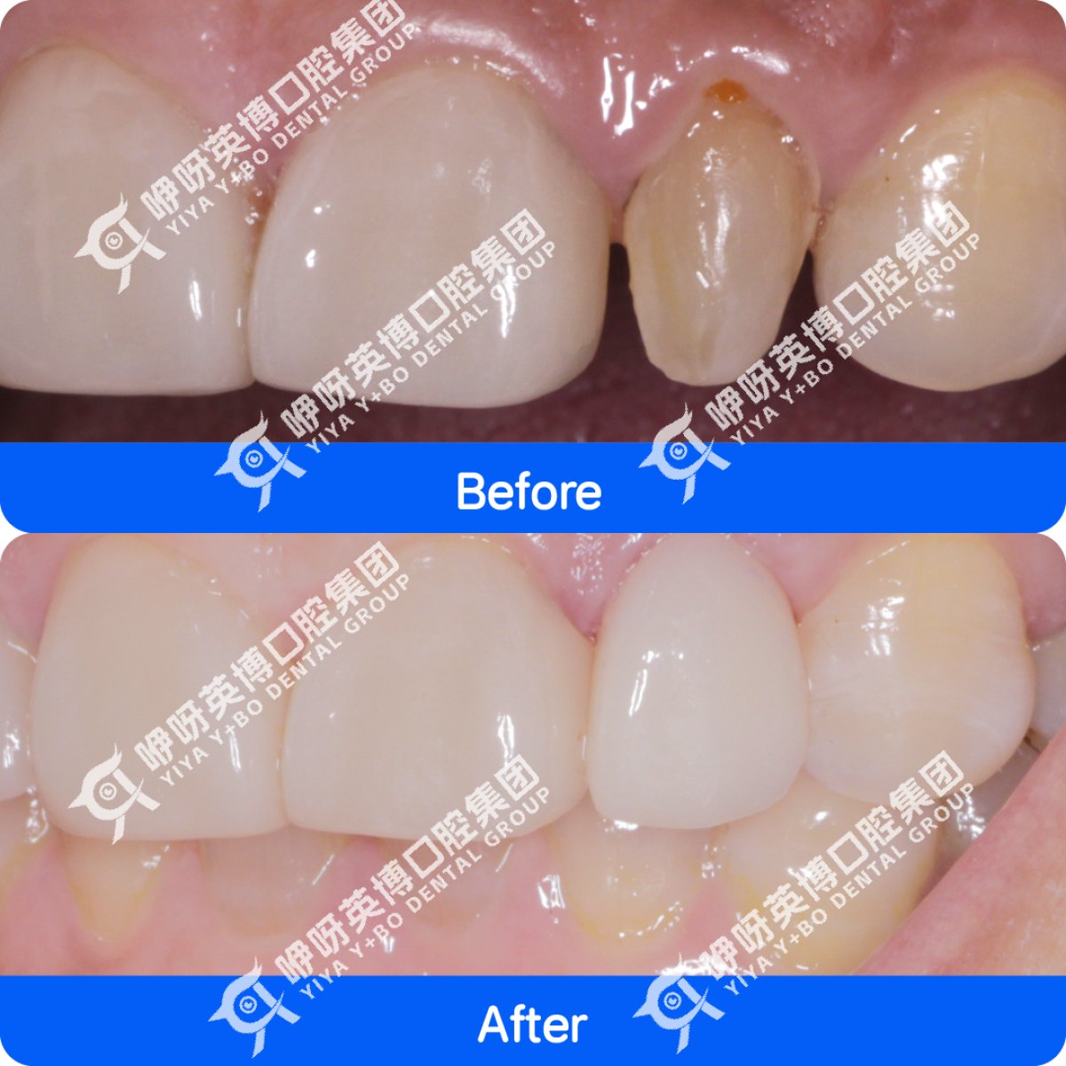 Before and after Immediate All-on-4 dental implants result at Shanghai Y+bo Dental Clinic