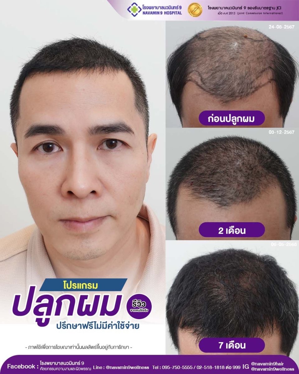 Hair transplant before and after results at Department of Skin & Surgery - NAVAMIN9 HOSPITAL