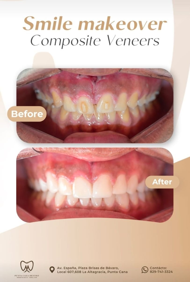 Résultat avant-après facettes composites chez Punta cana dentist odontologia familiar, sourire