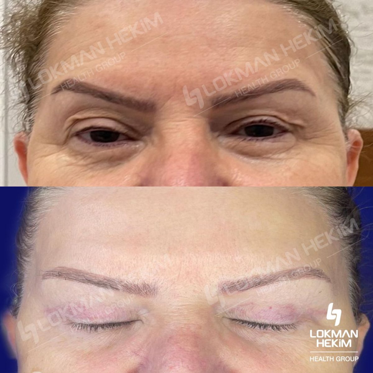 Resultados de cirugía de párpados superior e inferior en Lokman Hekim Istanbul Hospital, rejuvenecimiento ocular
