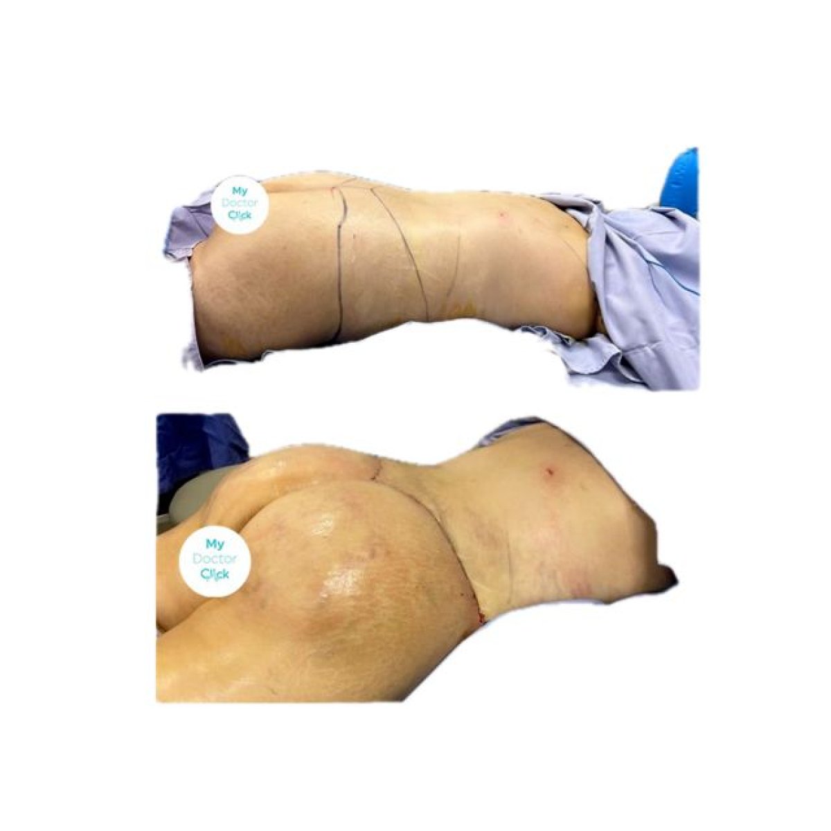 Before and after liposuction results at Hospital de la Familia, visible body contour improvement