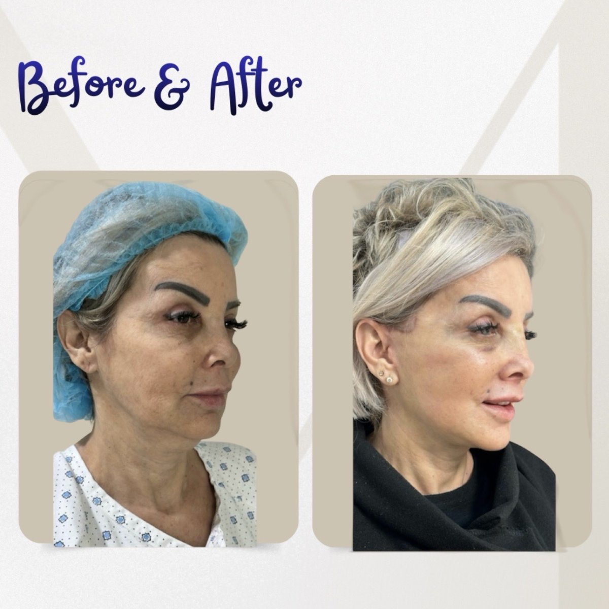 نتائج شد الوجه قبل وبعد في عيادة Dr. Michel Salameh - Plastic And Aesthetic Surgery