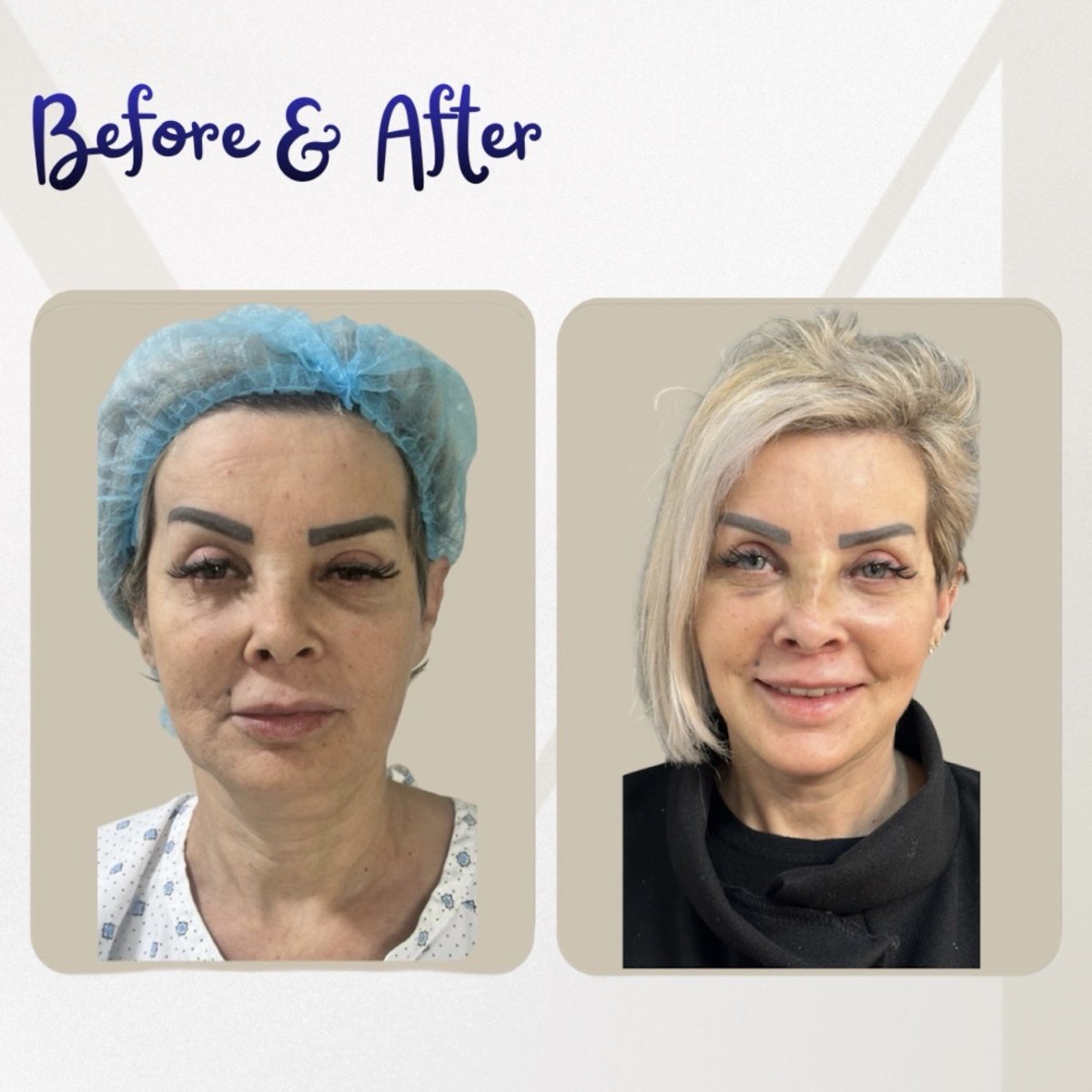 نتائج شد الوجه قبل وبعد في عيادة Dr. Michel Salameh - Plastic And Aesthetic Surgery