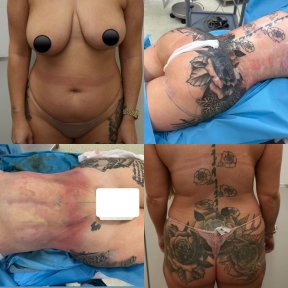 Brazilian Butt Lift Package - photo 5