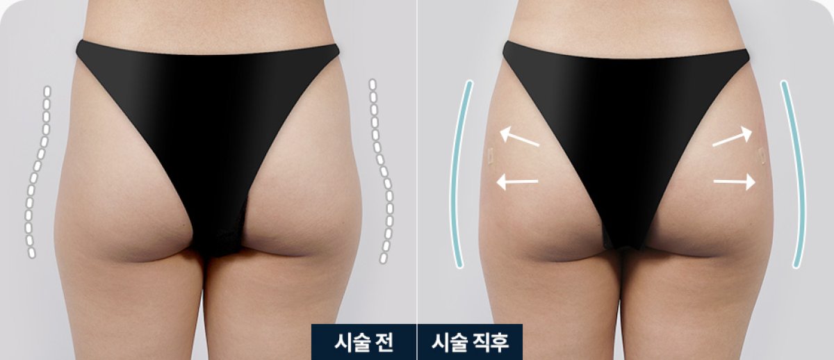 Resultados de liposucción de glúteos antes y después – contorno mejorado y apariencia más delgada