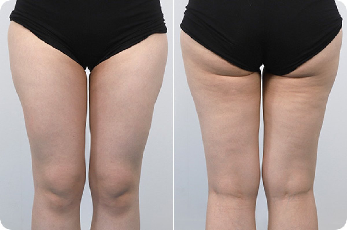Before and after fat reduction results on thighs, visible contour improvement after procedure