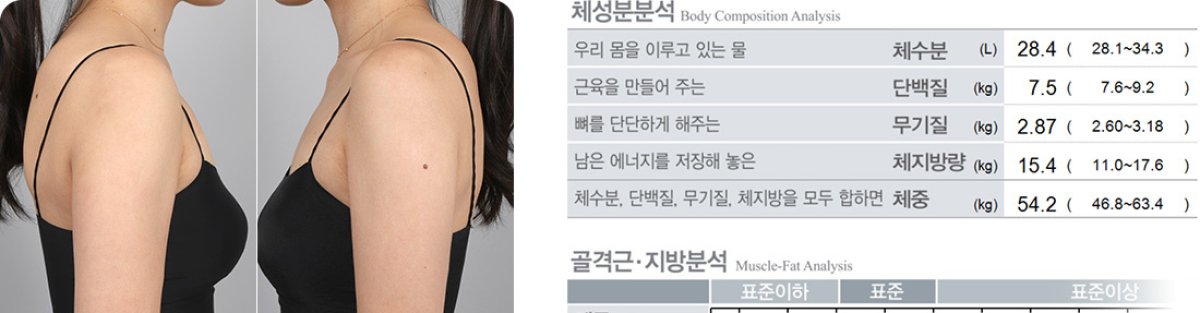 Before and after fat reduction results, visible arm contour improvement at clinic